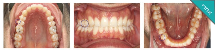 איירוק לפני ואחרי