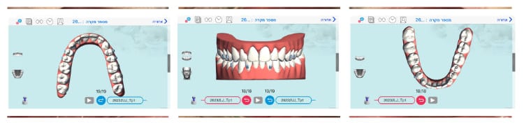 יישור שיניים שקוף תמונות
