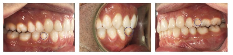 אינויזליין לפני ואחרי