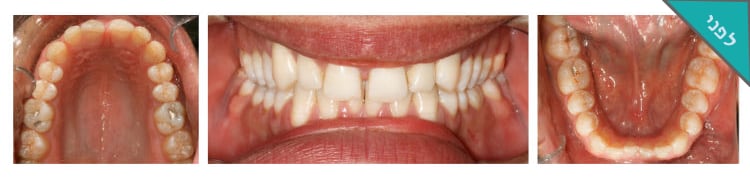 פלטה שקופה לאחר גשר