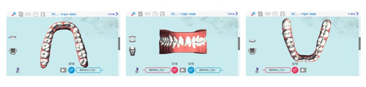 יישור שיניים שקוף לפני ואחרי