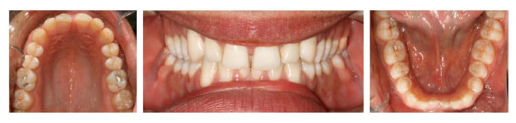 גשר שקוף תמונות