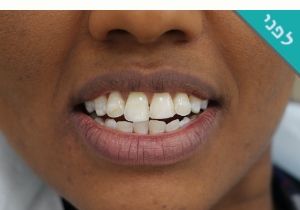 ציפוי שיניים שבורות לפני ואחרי