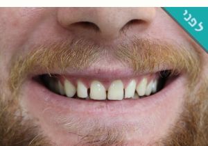 סגירת רווחים בשיניים תמונות לפני ואחרי