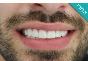ציפוי שיניים למינייט תמונות לפני ואחרי