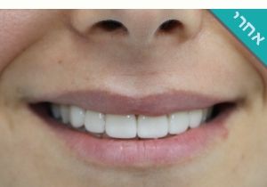 תיקון חיוך באמצעות ציפוי שיניים תמונות לפני ואחרי