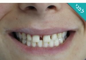תיקון חיוך באמצעות ציפוי שיניים תמונות לפני ואחרי