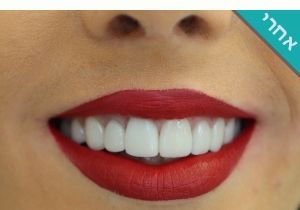 ציפוי שיניים ד״ר מירי פיצ׳ר לפני ואחרי