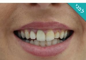 ציפוי שיניים ד״ר מירי פיצ׳ר לפני ואחרי