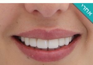 ציפוי שיניים רופאת שיניים מירי פיצ׳ר לפני ואחרי