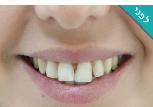 ציפוי שיניים רופאת שיניים מירי פיצ׳ר לפני ואחרי