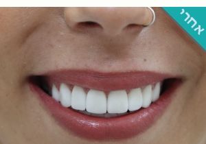 ציפוי שיניים emax תמונות לפני ואחרי