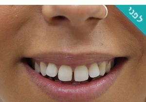 ציפוי שיניים emax תמונות לפני ואחרי
